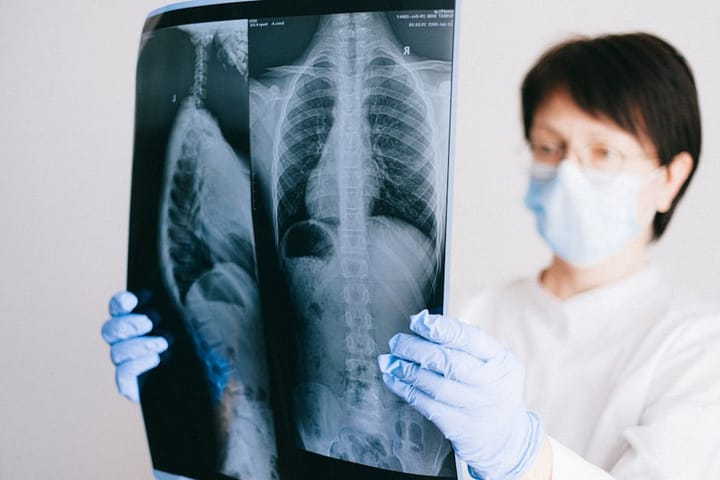 Lung Cancer Screening for Former Smokers: The Test Most Miss